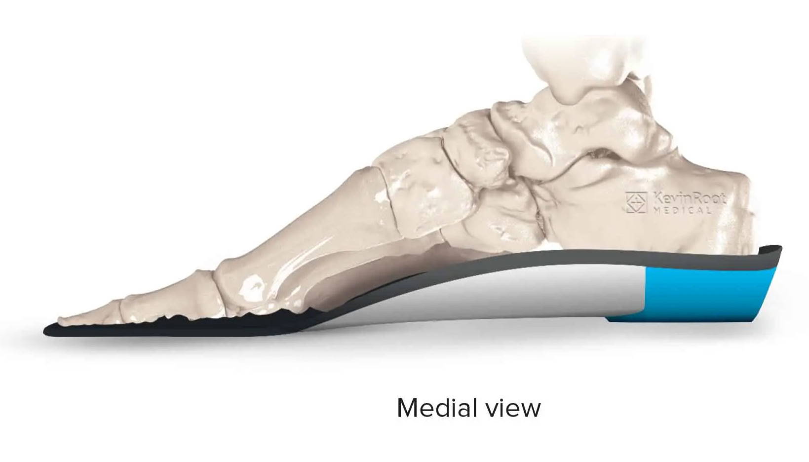 Lateral Oblique Extrinsic Rearfoot Post – KevinRoot Medical