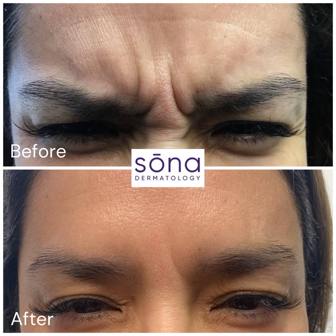 Sona - Botox Cosmetic Before & After 3