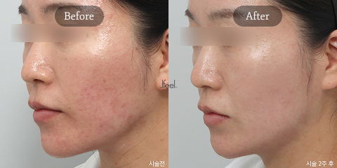 BB Laser Lavieen for Glass Skin and Korean Summer Skin Treatments Targeting Pigmentation, Acne Marks, and Enlarged Pores