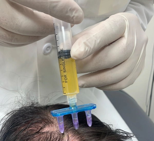 PRP for Hair Loss treatment at prolase.