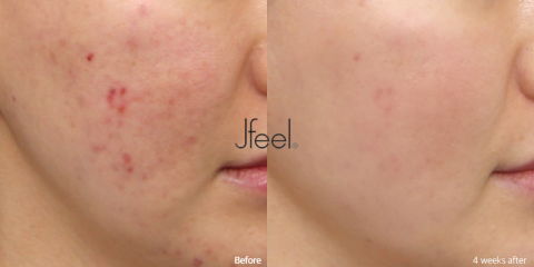 Inflammatory Acne Treatment Showing Four Week Clinical Improvement Results