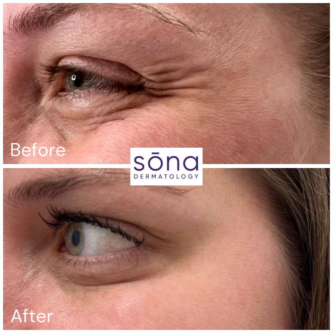 Sona - Botox Cosmetic Before & After 11