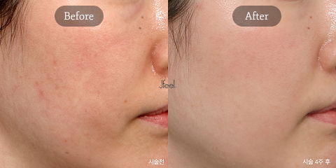 Exosome Therapy for Acne Redness Reduction, Skin Regeneration, and Glass Skin Recovery in Korean Dermatology Clinics