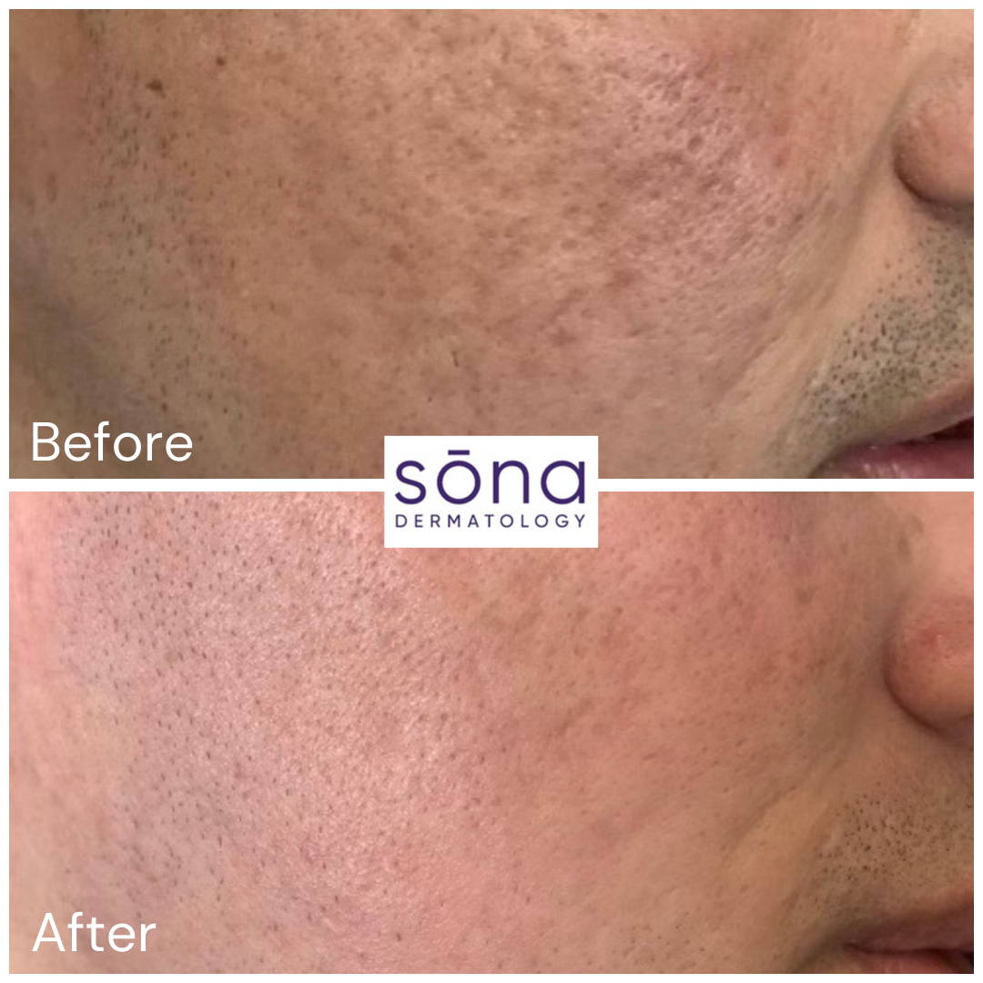 Sona SkinPen Microneedling Before & After