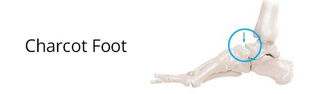 Charcot Foot