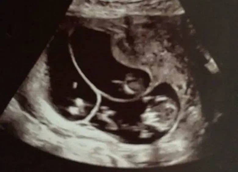 Charlotte expecting triplets 