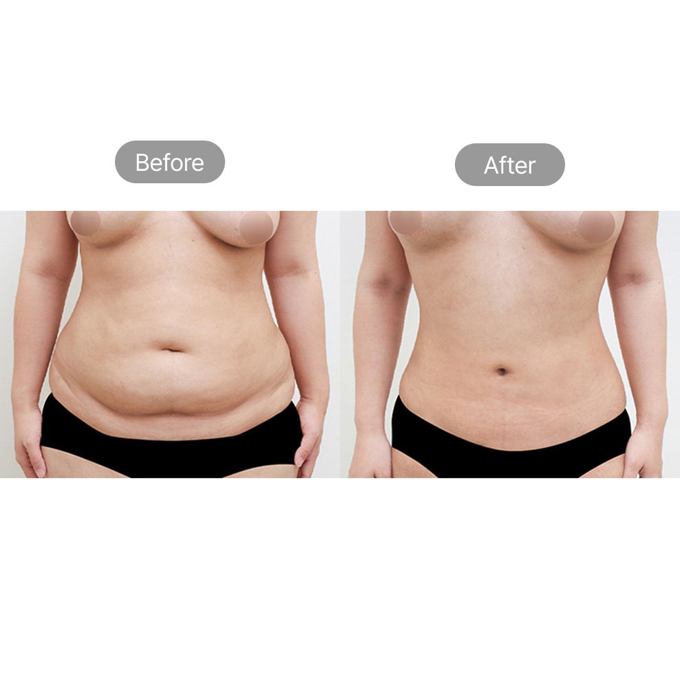 Lower abdominal liposuction before and after results for waist and belly contouring in Korea