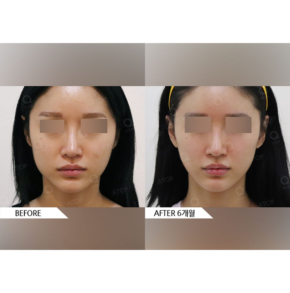 Before and after results of square jaw reduction surgery showing a slimmer V-line face and improved facial balance in Korea