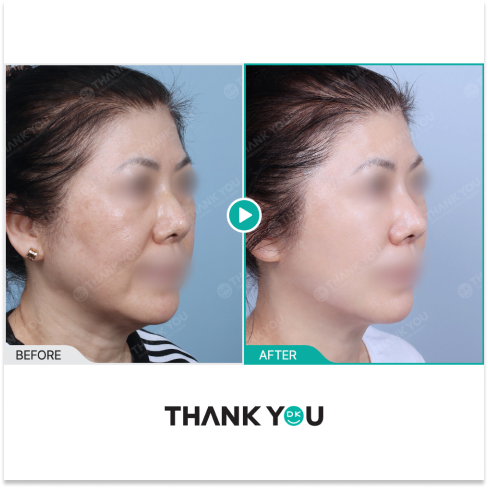 Side profile improvement for sagging skin using Shurink HIFU and InMode RF, enhancing facial contour and tightening skin appearance