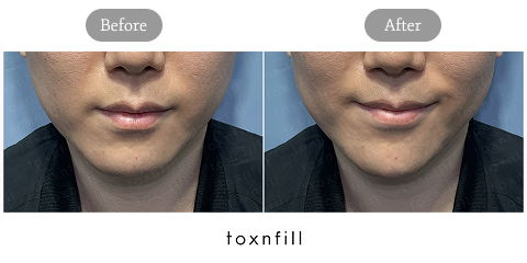 Jawline Contouring Korea with Male Jaw Fillers for Sharper Facial Definition and Natural Masculine Balance