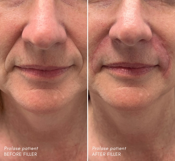 Prolase Patient before and after 2ml Juvederm Ultra plus in NL Folds with Mane Kharbertyan.