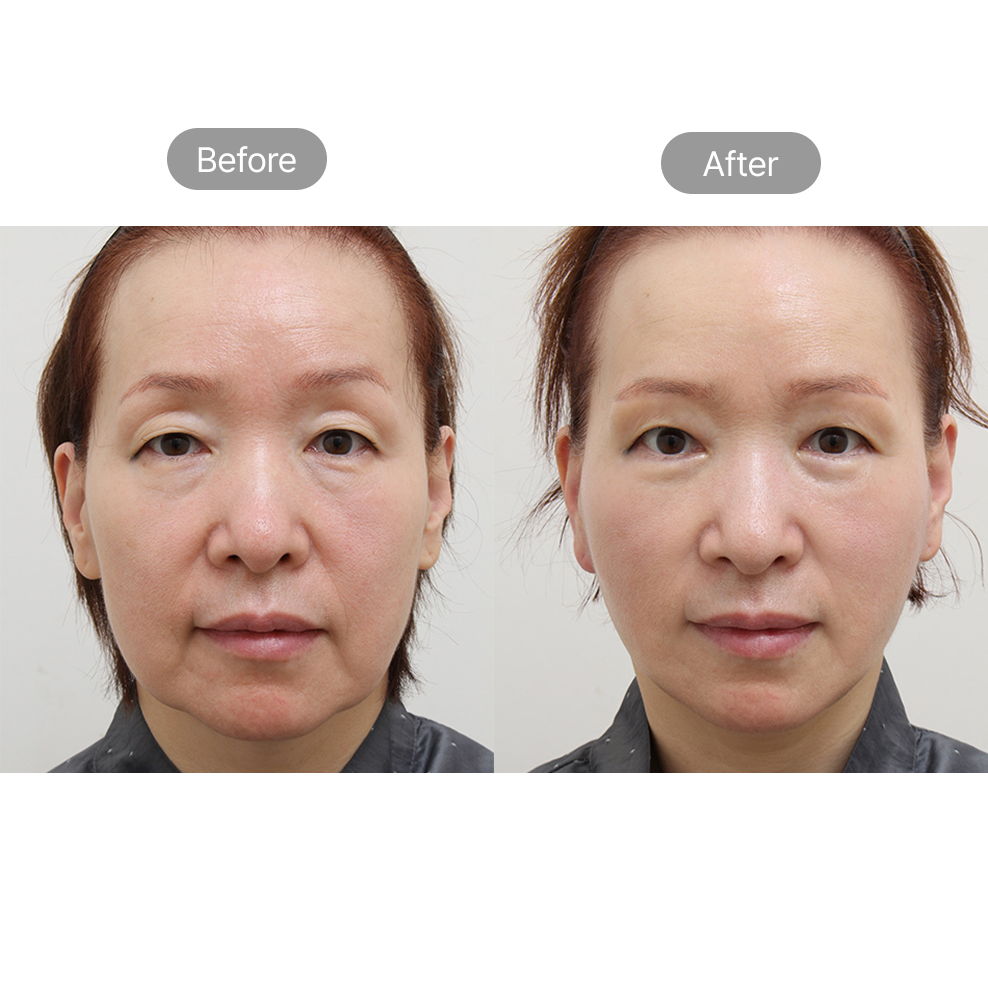 Mini facelift before and after results for natural facial rejuvenation at Fresh Dr. Hong in Korea