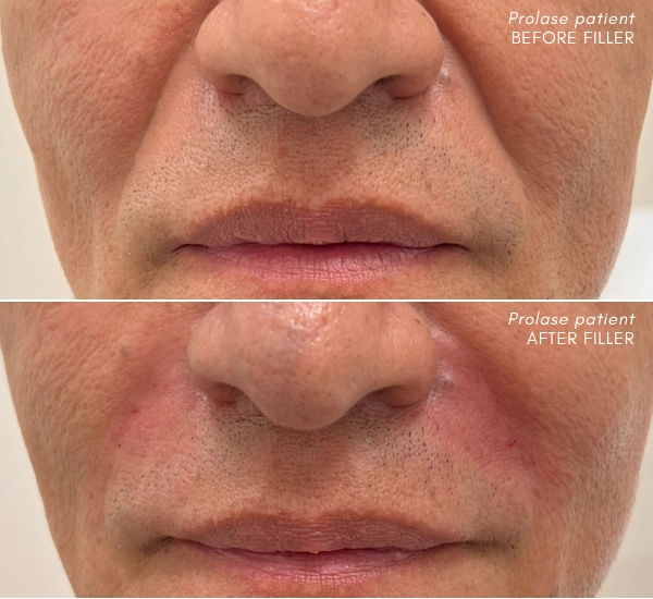 Prolase Patient before and after 2ml Juvederm ultra plus in NL folds with Mane Kharbertyan