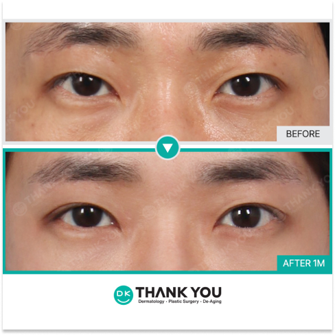 Male Plastic Surgery in Korea for Looksmaxing, Natural Eye Enhancement, Male Rhinoplasty, and Botox for Men