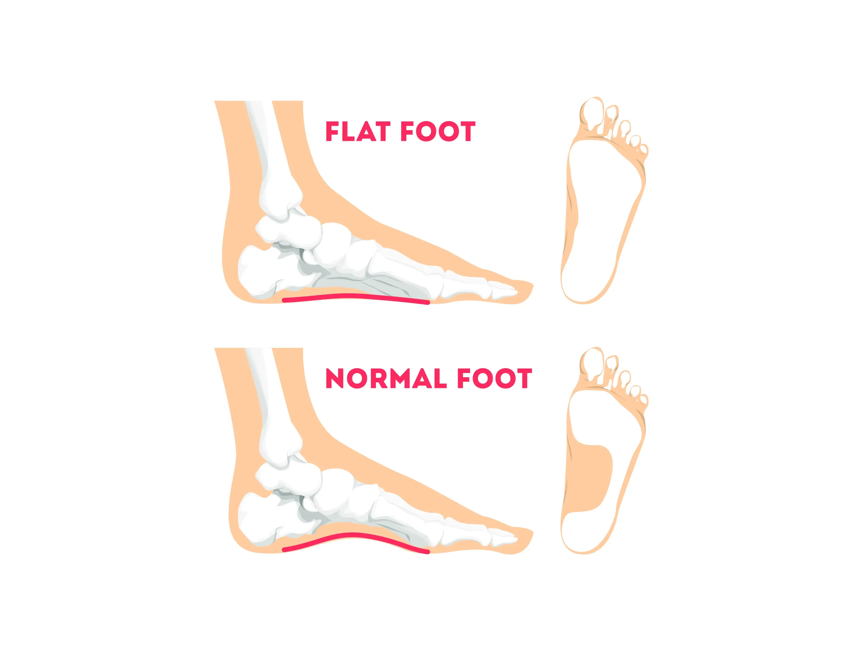 flat feet vs normal feet