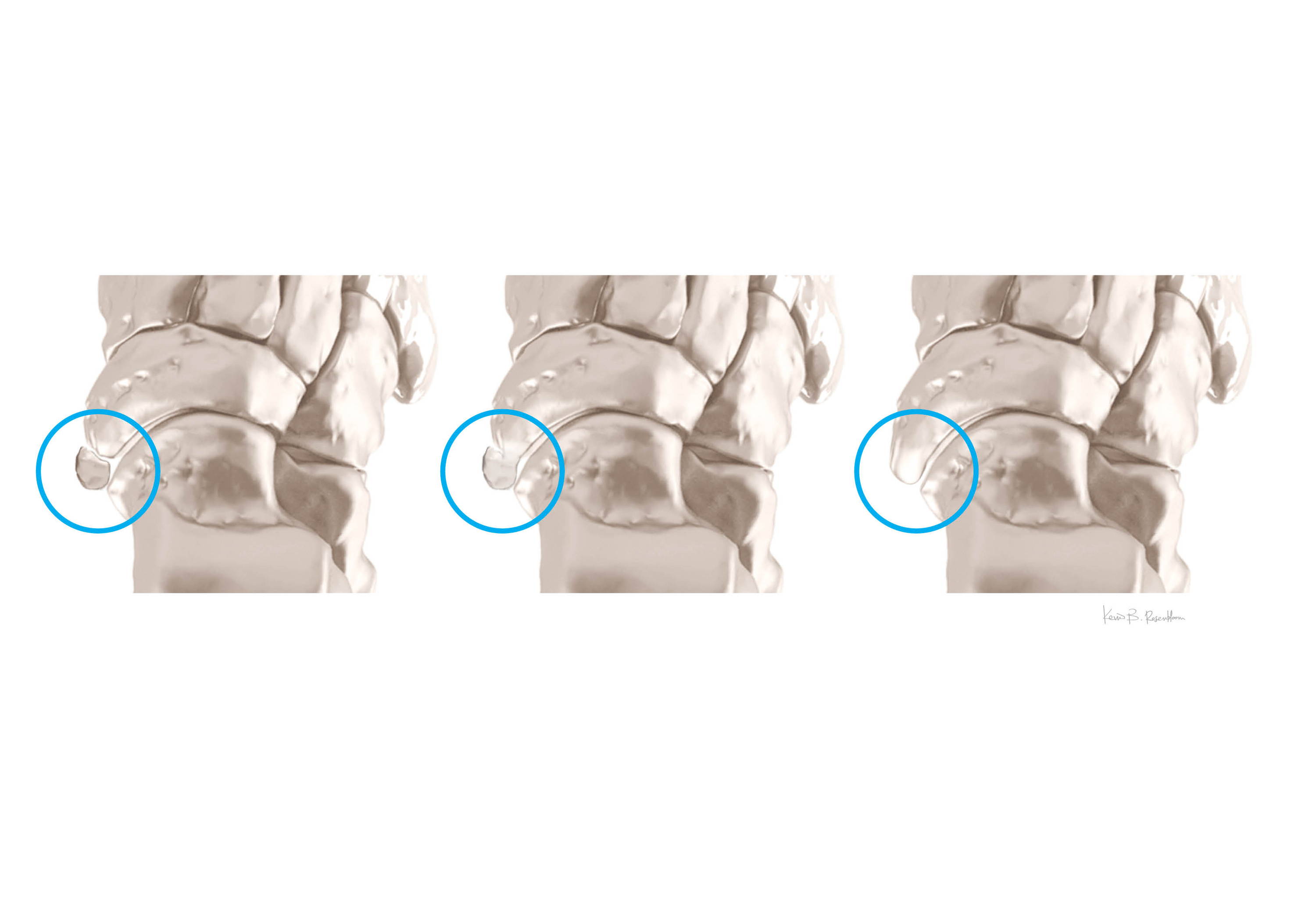 Accessory Navicular Syndrome