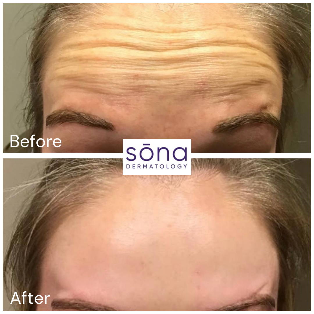 Sona - Botox Cosmetic Before & After 16