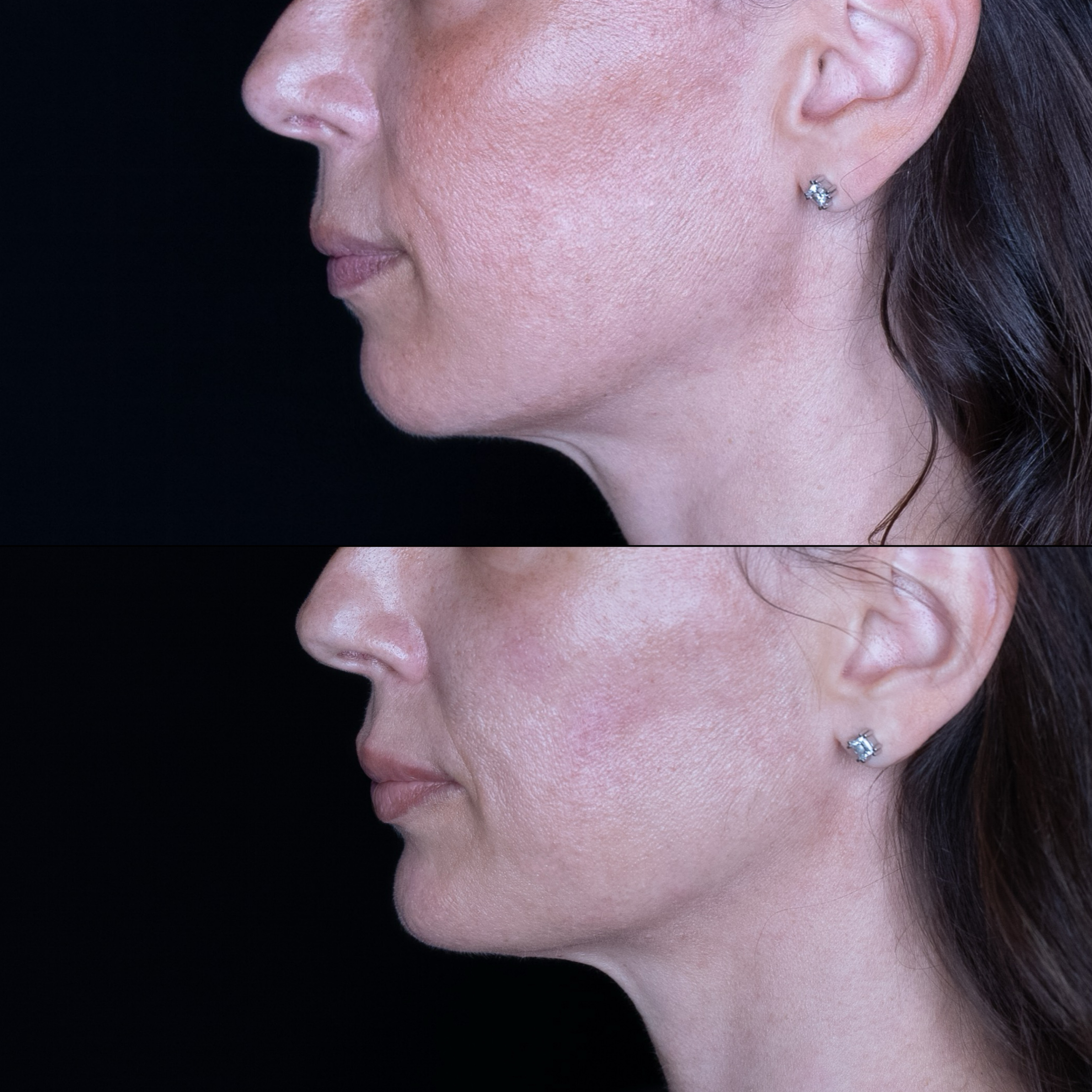 Side profile comparison of a woman's face before and after treatment.