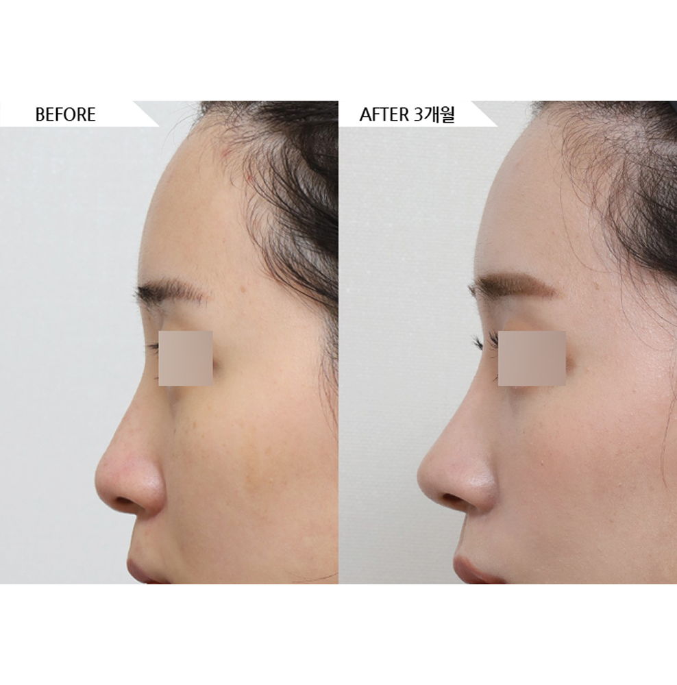 Before and after results of 3D rhinoplasty and bulbous nose correction showing a more defined and natural nose profile in Korea