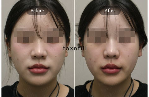 Juvelook Volume Before and After for Nasolabial Folds and Lateral Cheek Volume