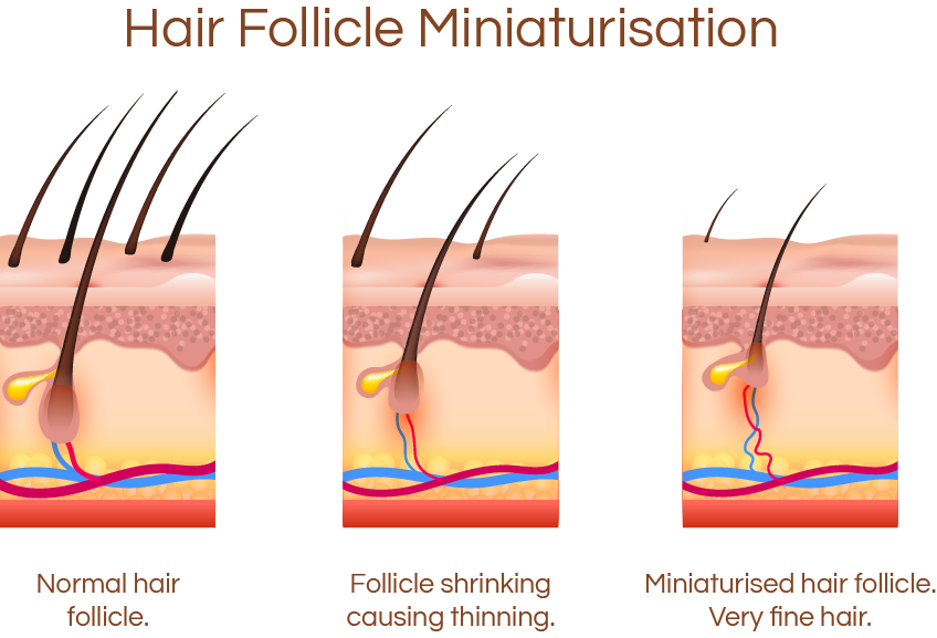 Illustration showing hair follicle miniaturization stages.
