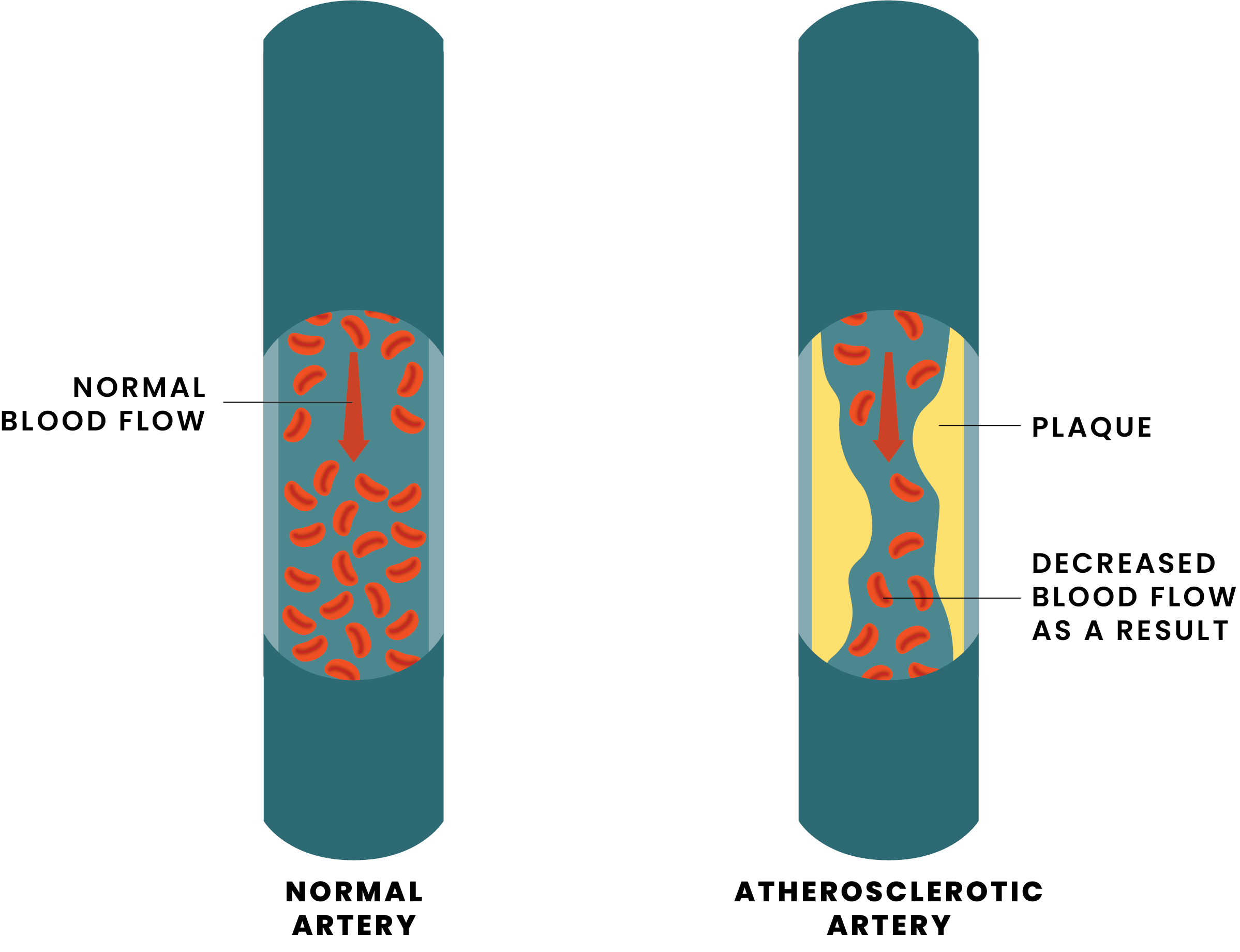 Infographic of Peripheral Artery Disease