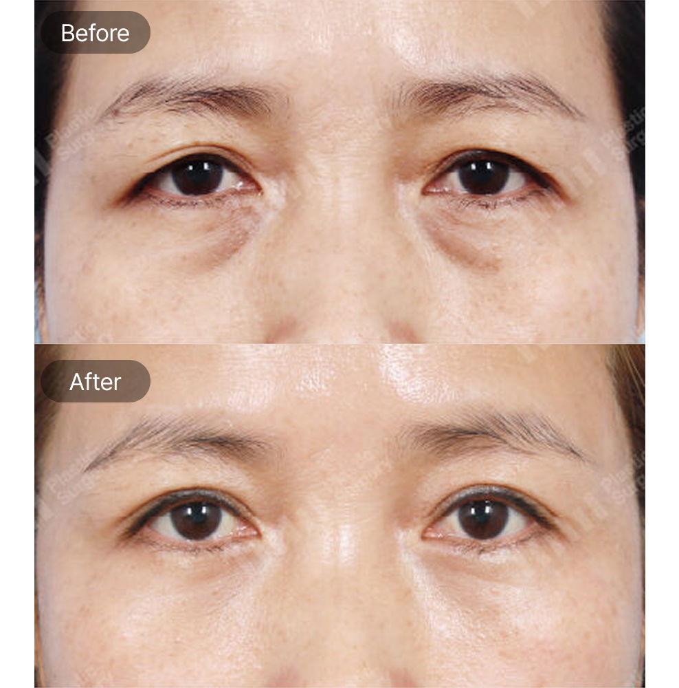 Upper Blepharoplasty Before and After Results at 1MM Plastic Surgery in Korea for Refreshed and Youthful Eyes