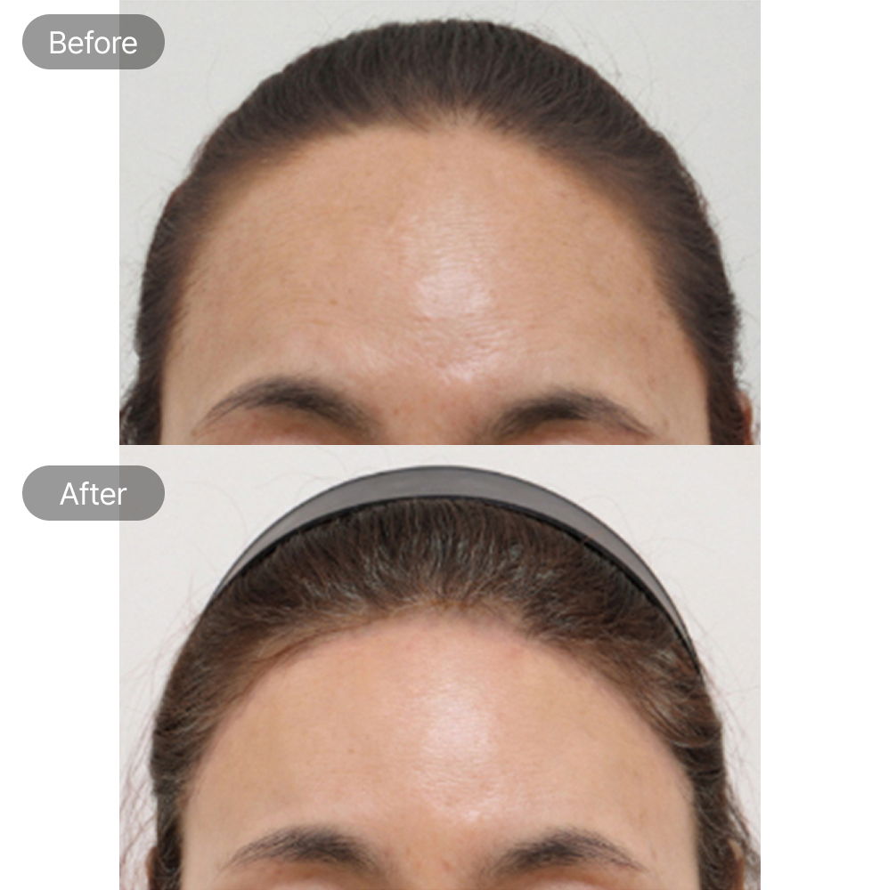 Forehead lift before and after results at Fresh Dr. Hong Plastic Surgery in Korea
