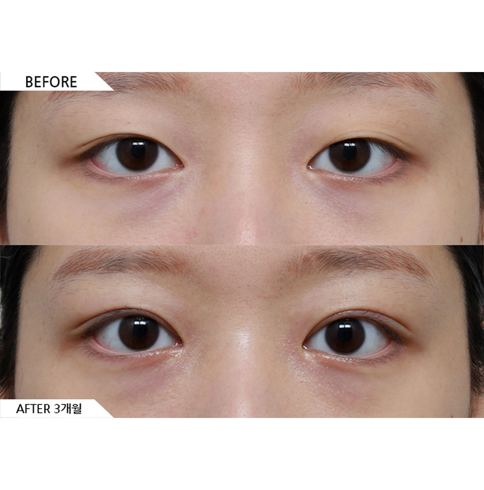 Before and after results of non-incisional double eyelid surgery using buried suture method for natural and subtle eye enhancement in Korea