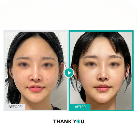 Korean skin rejuvenation treatments combining laser and Rejuran Healer to improve skin tone and clarity after personalized Korean skincare consultation