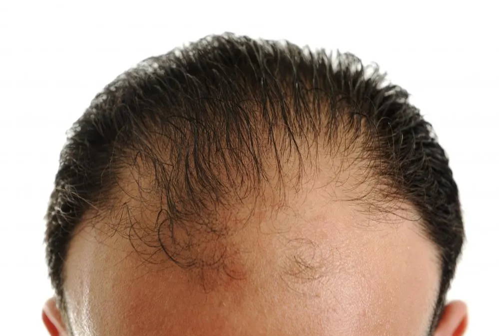 Does Minoxidil (Rogaine) With Frontal Baldness? – DS