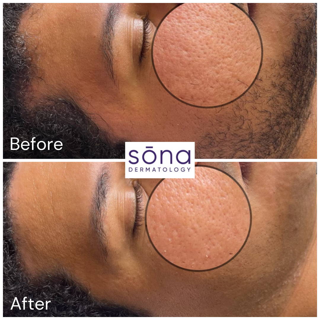 Sona SkinPen Before & After 5