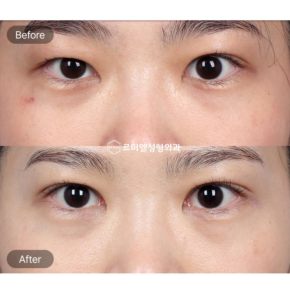 Before and After Results of Revision Non Incisional Ptosis Correction After Six Months