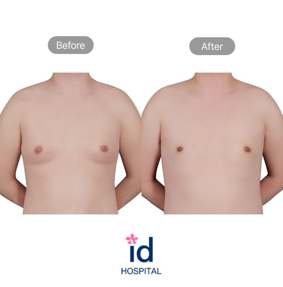 ID Hospital Male Gynecomastia Surgery Before and After Result