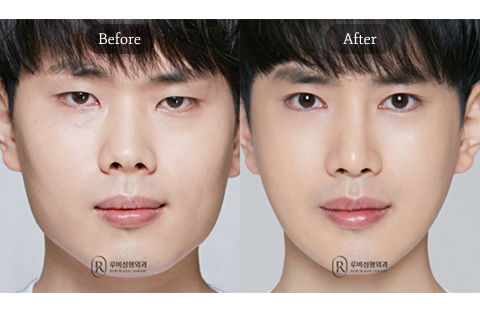Male Facial Balancing Before and After in Korea Featuring Eye Shape Correction, Short Nose Refinement, Cheekbone Reduction, and Square Jaw Contouring