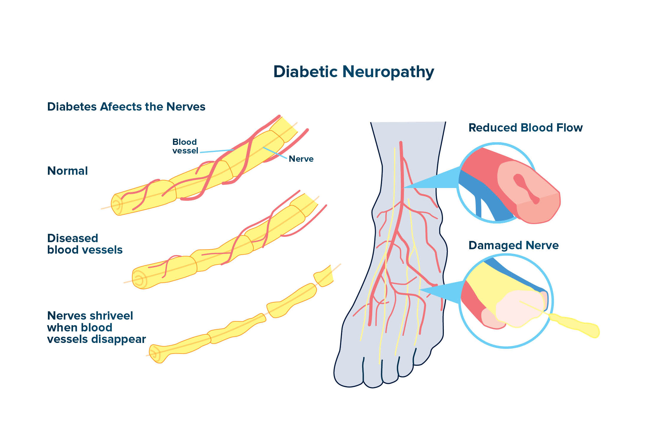 Ankle & Foot Related Neuropathy
