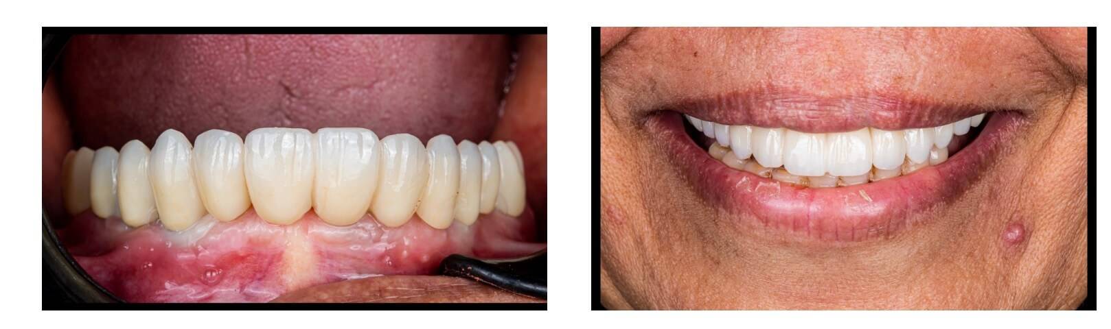 The result of teeth implant and restoration