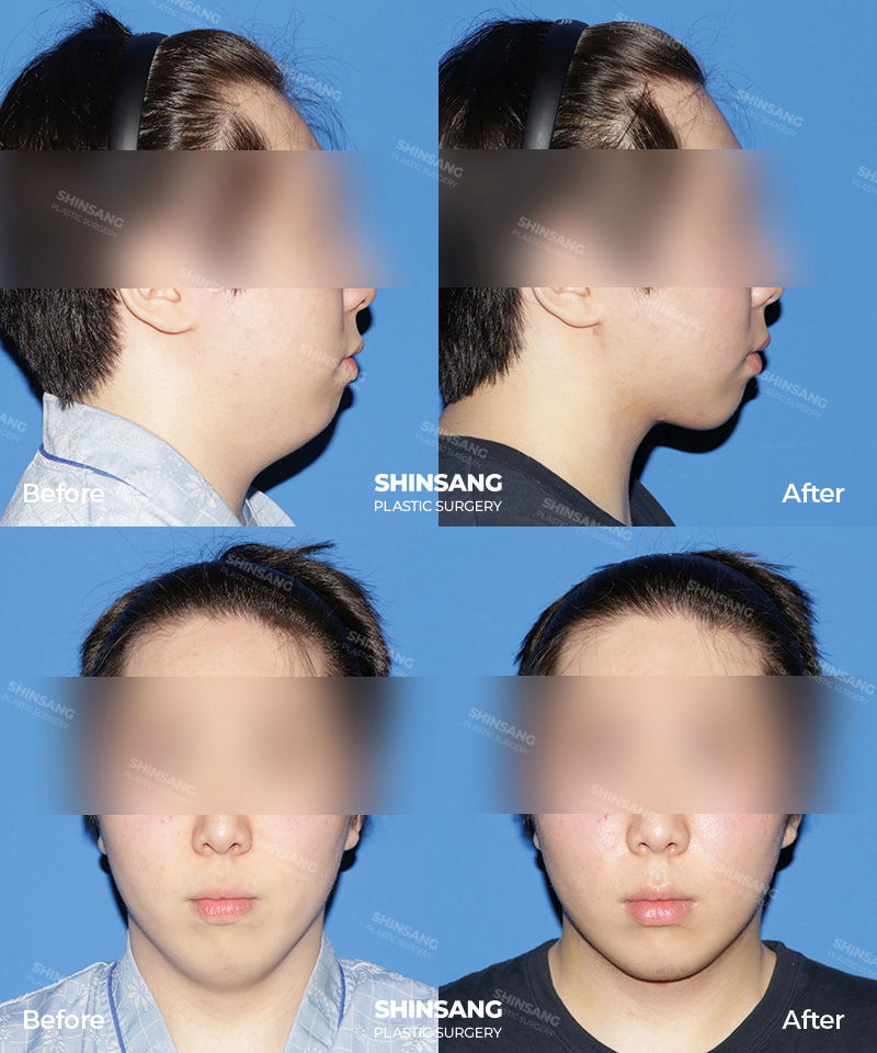 Neck Reduction Toad Neck Surgery Result At Sinsang Plastic Surgery In Korea
