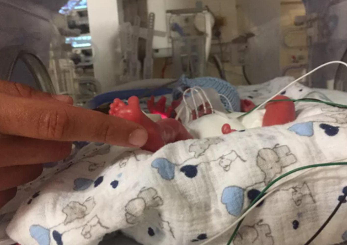 A finger pointing at a newborn in a hospital incubator.