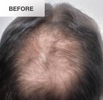 image of mens hair loss before lllt