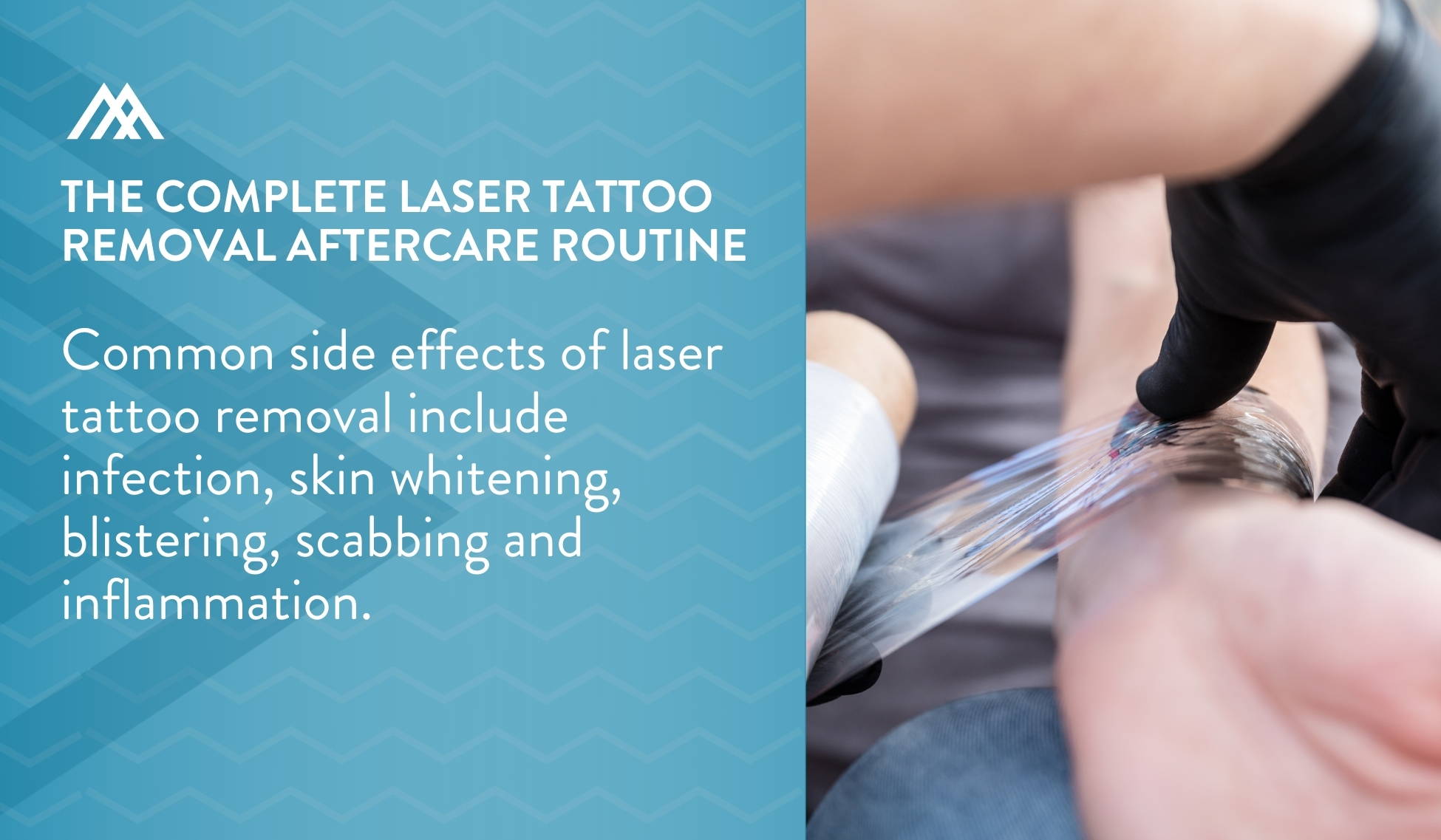 The Complete Laser Tattoo Removal Aftercare Routine - Amandean