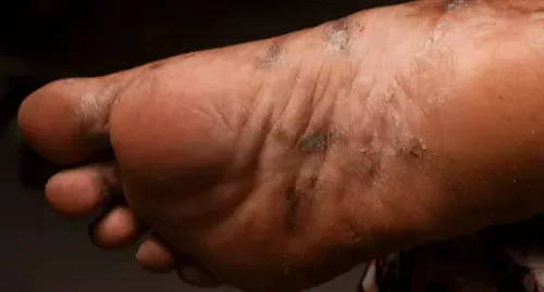 Jemand mit dunklerer Haut mit einem violetten, schuppigen Psoriasis-Ausschlag an der Fußsohle
