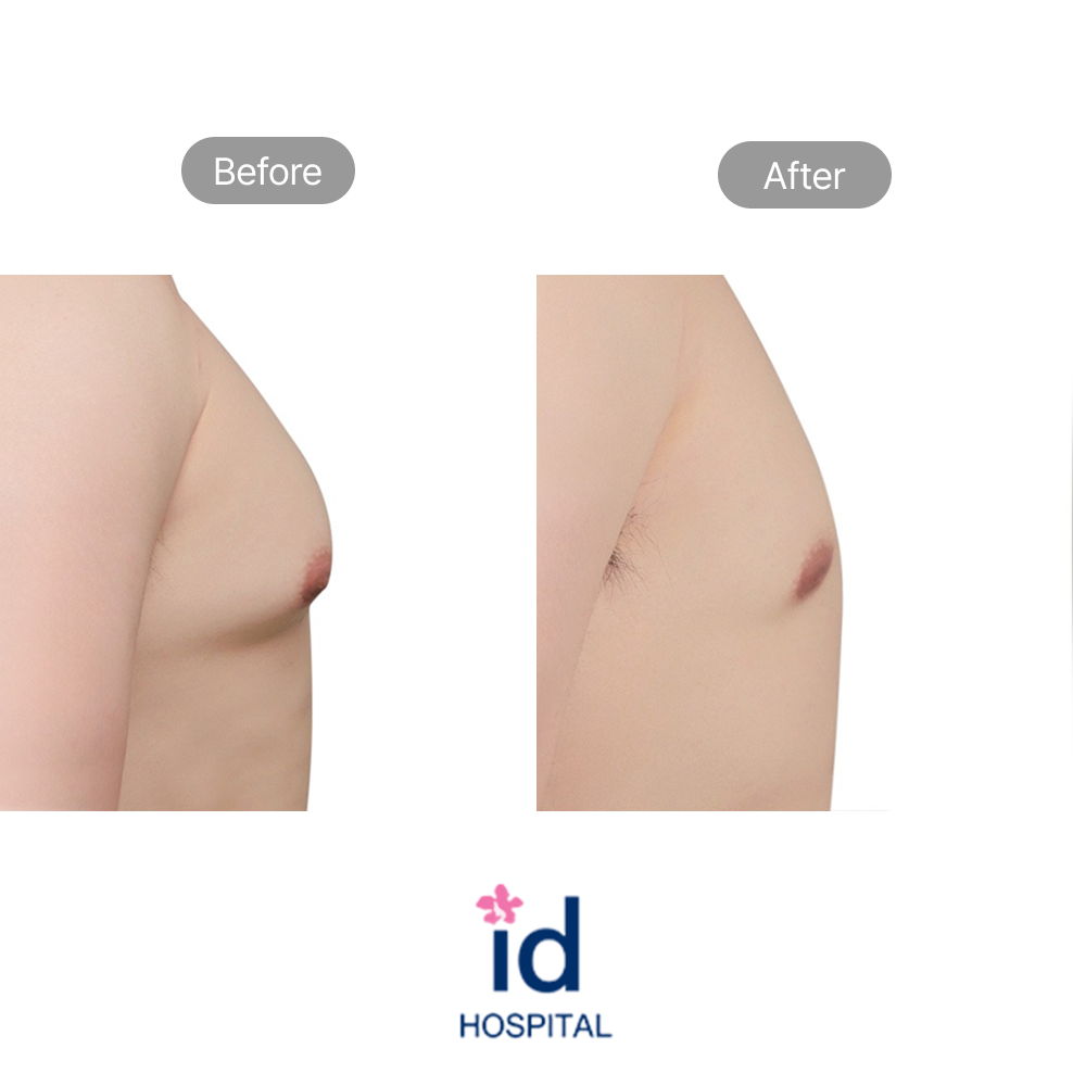Korean Male Gynecomastia Surgery Side View Before and After Result