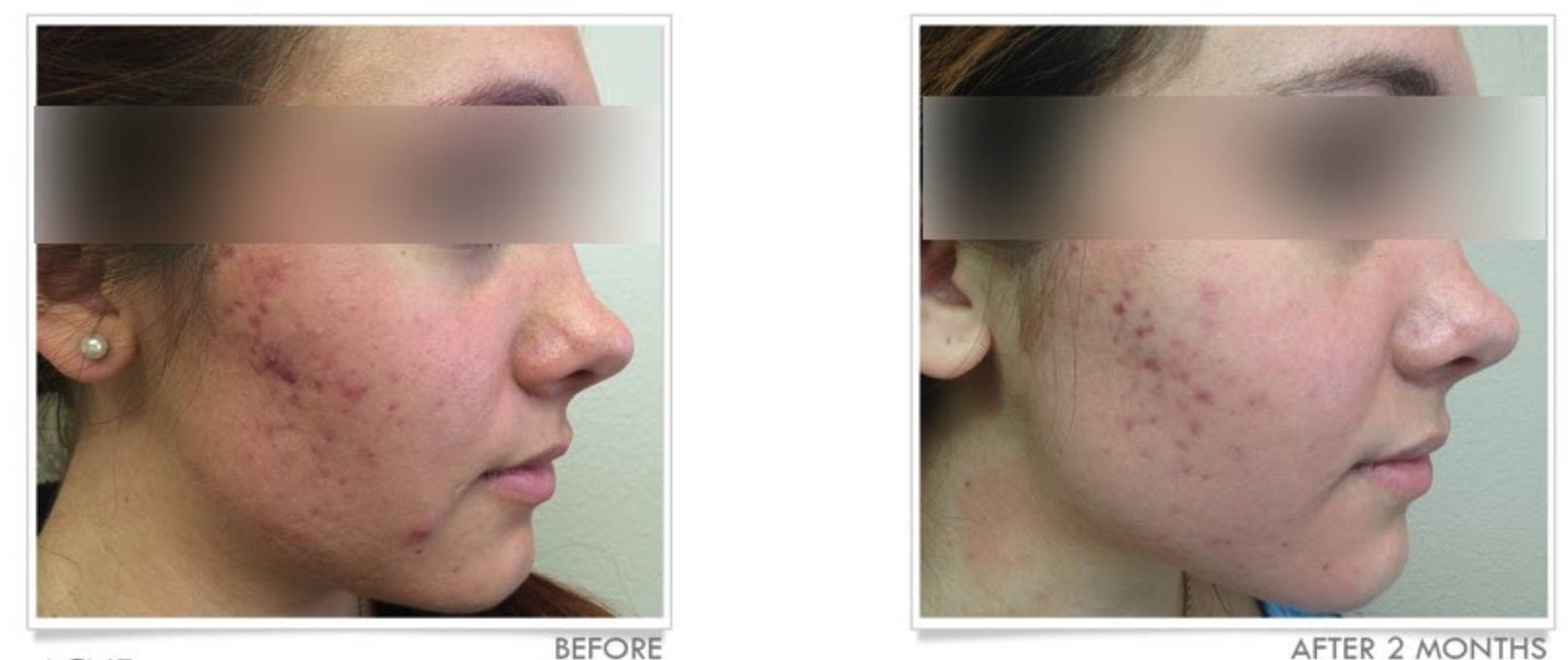 accutane acne care trademark hoffman roche registered inc