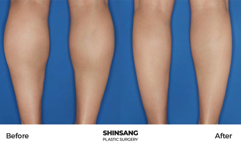 Calf Botox Leg Contouring Result At Sinsang Plastic Surgery In Korea