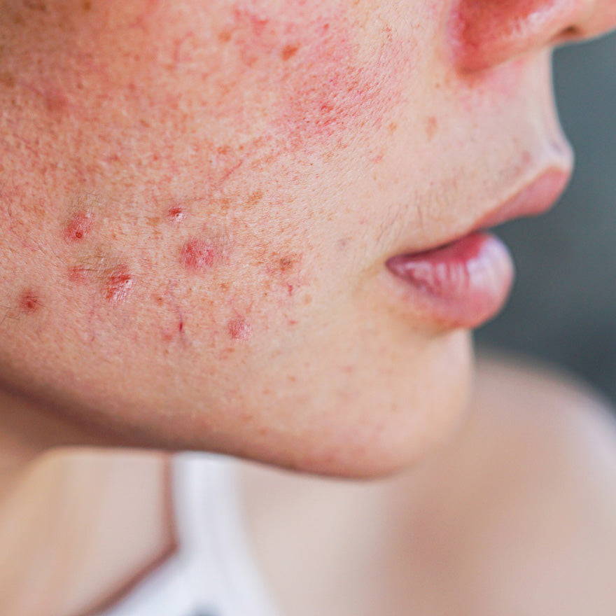 Woman with hormonal acne.