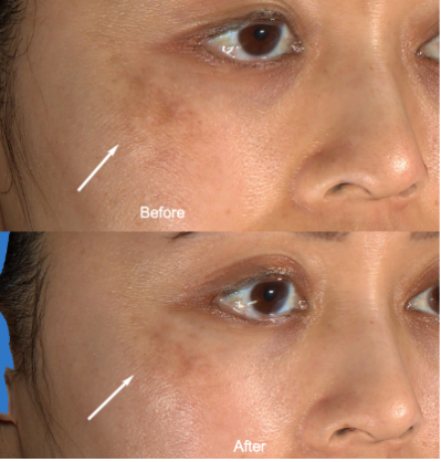 Before and After of Cheek Hyperpigmentation Using Skinuva Brite