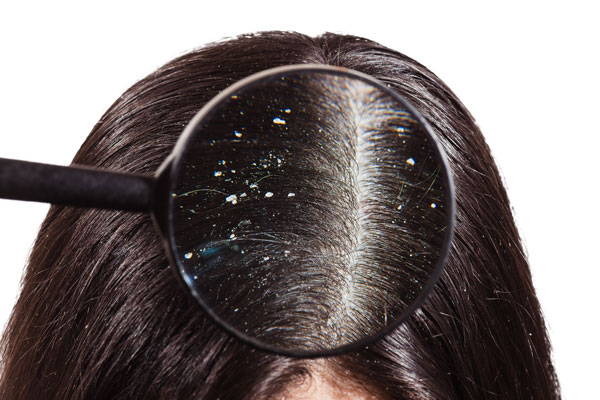 How Does Dandruff Occur & How Can I Manage It? – Capillus