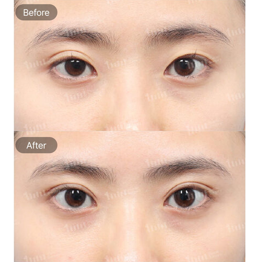 Incisional Double Eyelid Revision Surgery and Upper Epicanthoplasty Before and After Results at 1MM Plastic Surgery in Korea