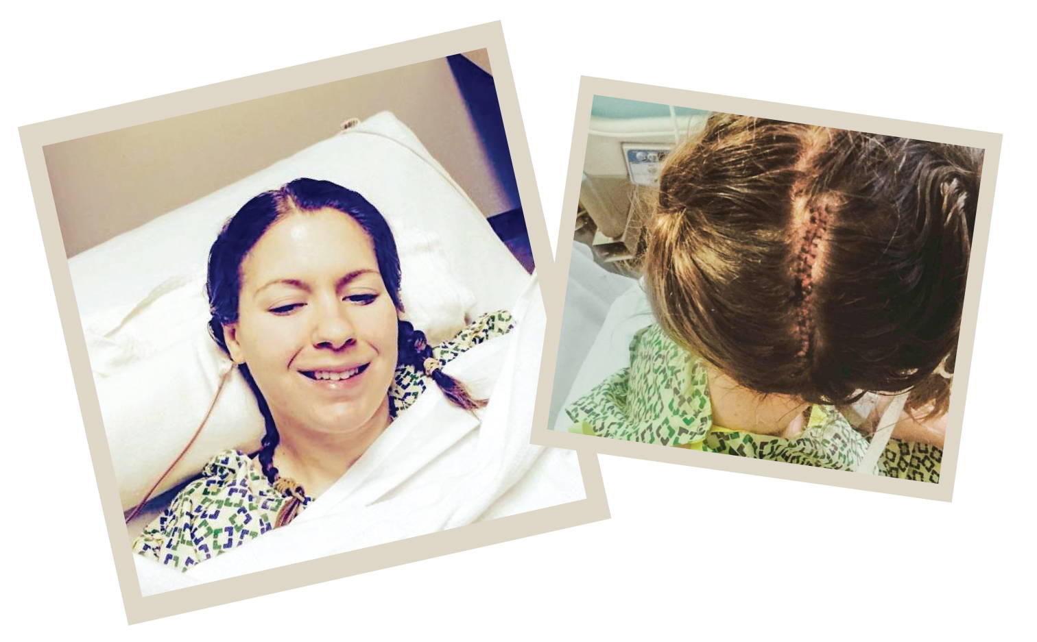 Left image: Molly Bookmyer recovers from brain surgery in her hospital bed. Right image: Molly Bookmyer shows her cranial scar from brain surgery